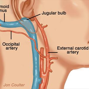 Iron Supplements Tinnitus - How To Stop Ringing In Ears - How To Stop Ringing In Ears When You Have Been Told That There Is No Cure For Tinnitus